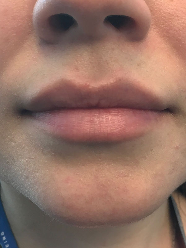 Injectables And Fillers 01