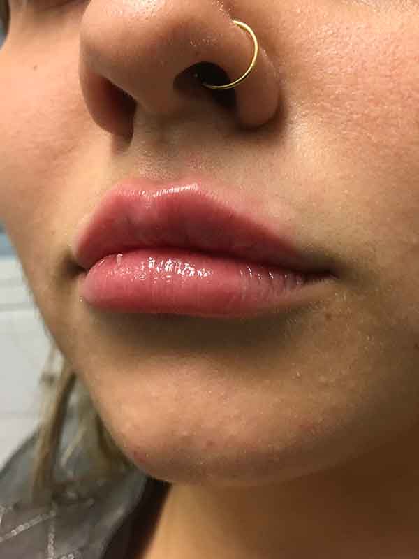 Injectables And Fillers 74