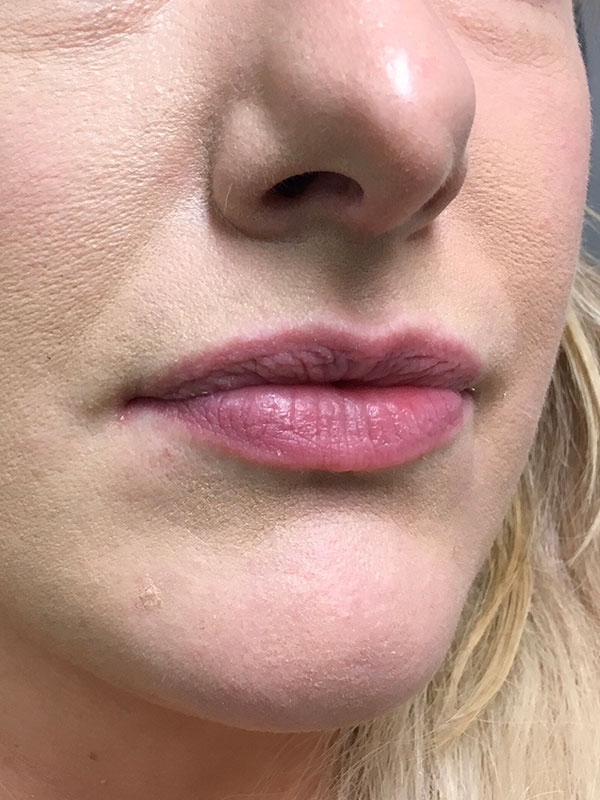 Injectables And Fillers 01