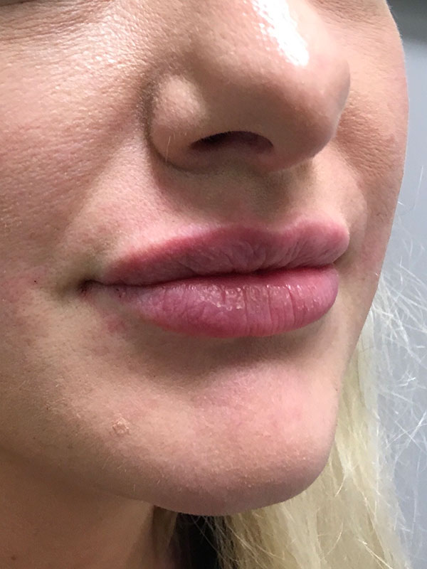 Injectables And Fillers 76