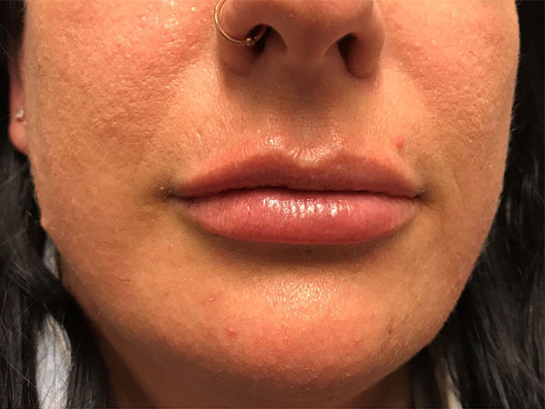 Injectables And Fillers 77