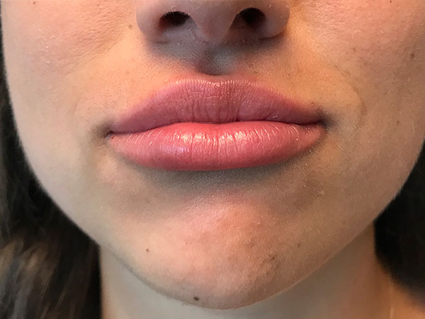 Injectables And Fillers 78