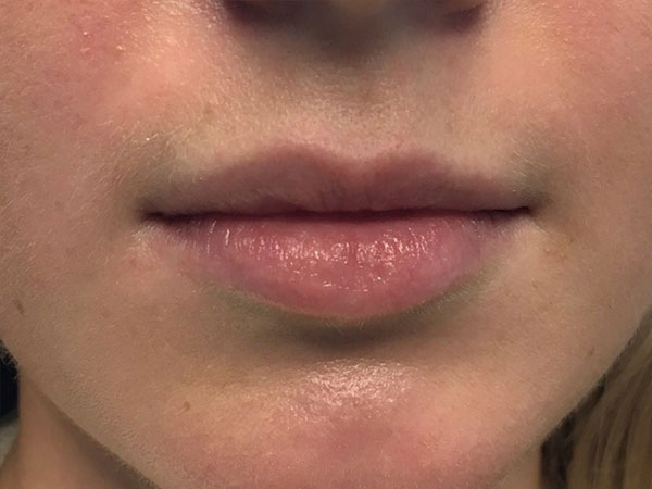 Injectables And Fillers 01