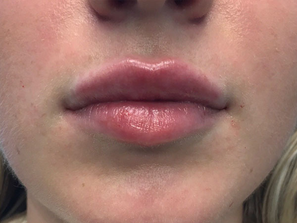 Injectables And Fillers 80