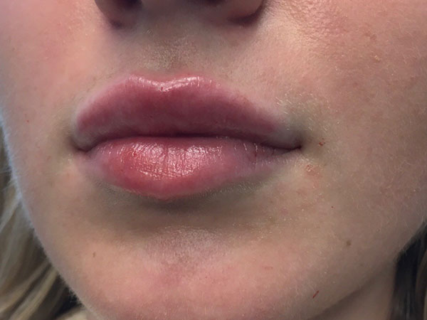 Injectables And Fillers 03