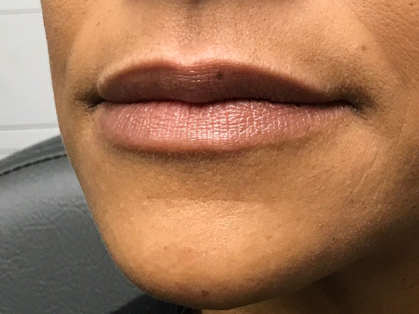 Injectables And Fillers 01