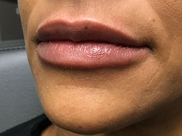 Injectables And Fillers 81