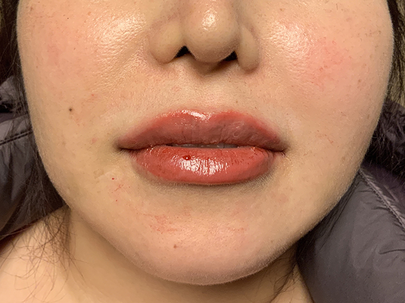 Injectables And Fillers 82