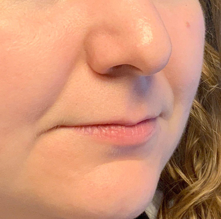 Injectables And Fillers 03