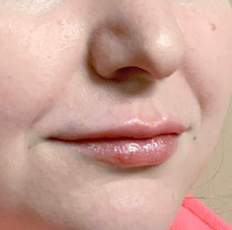 Injectables And Fillers 03