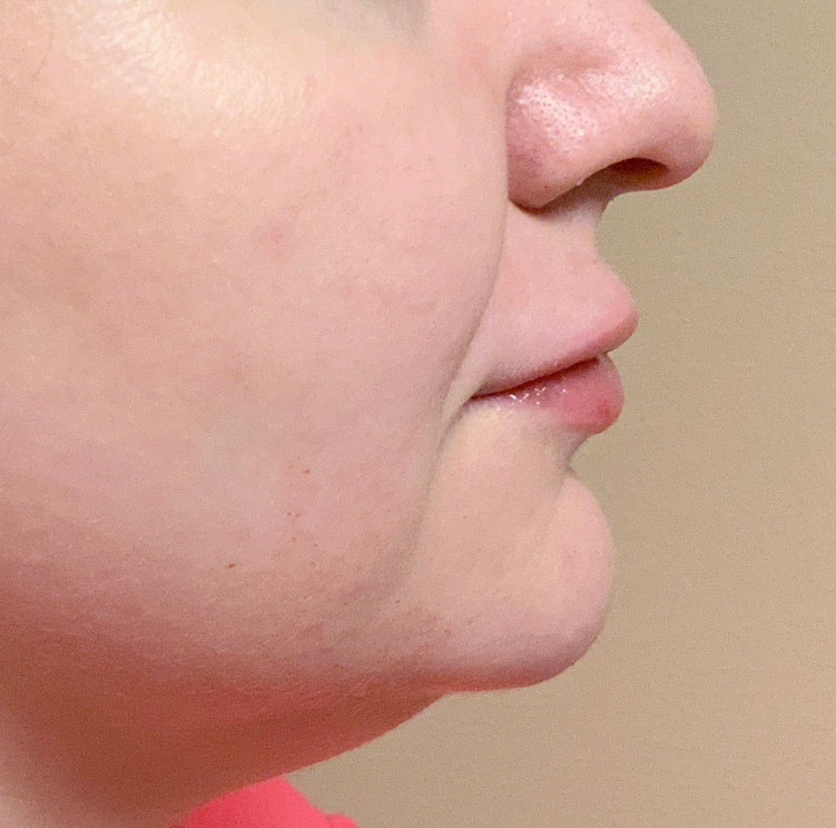 Injectables And Fillers 05