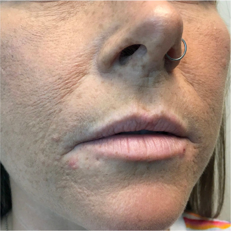 Injectables And Fillers 05