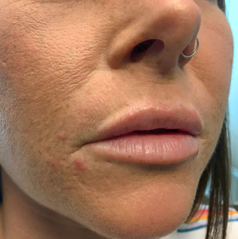 Injectables And Fillers 05