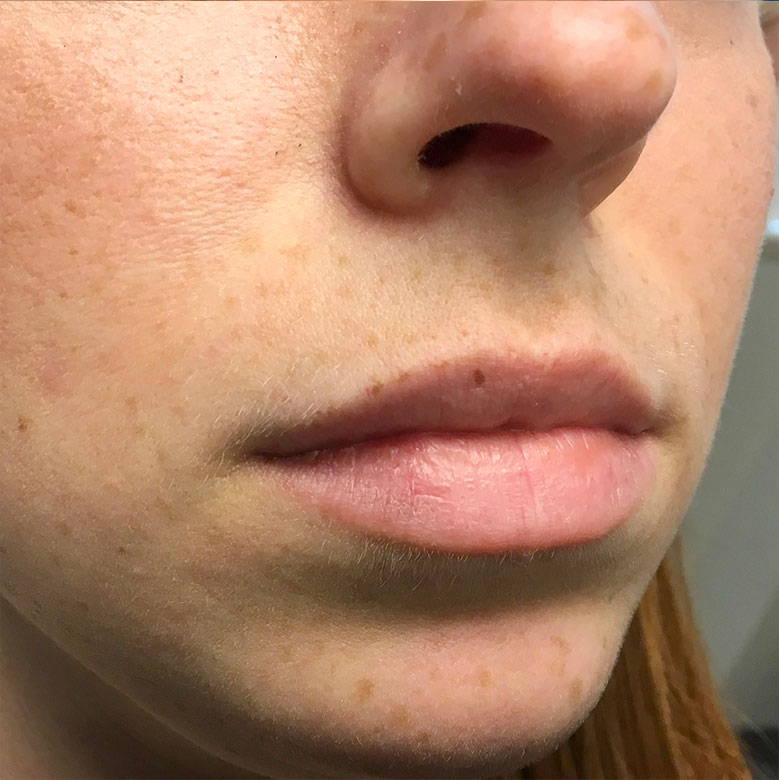 Injectables And Fillers 01