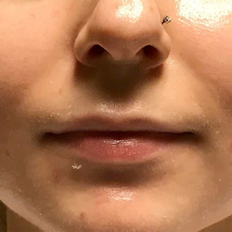 Injectables And Fillers 01