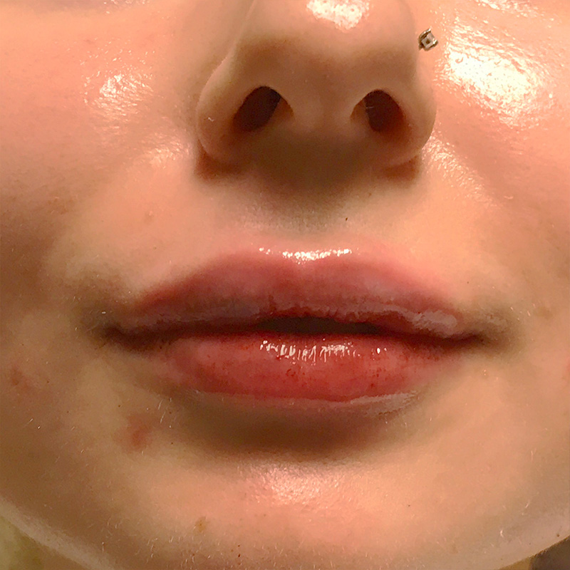 Injectables And Fillers 87