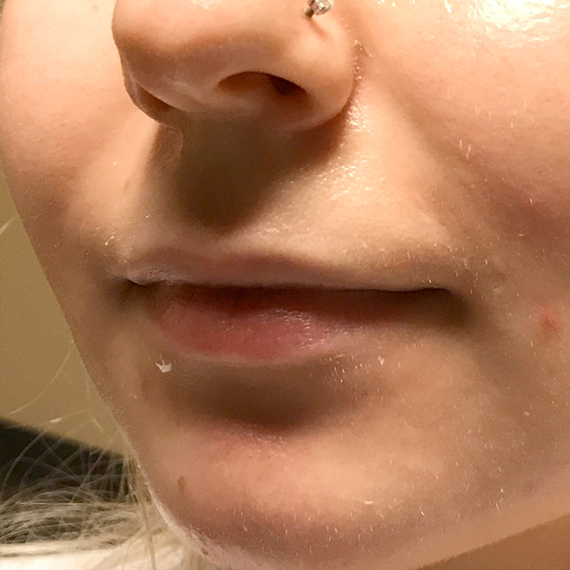 Injectables And Fillers 03