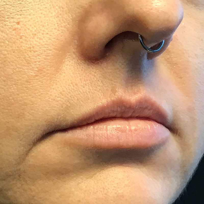 Injectables And Fillers 01