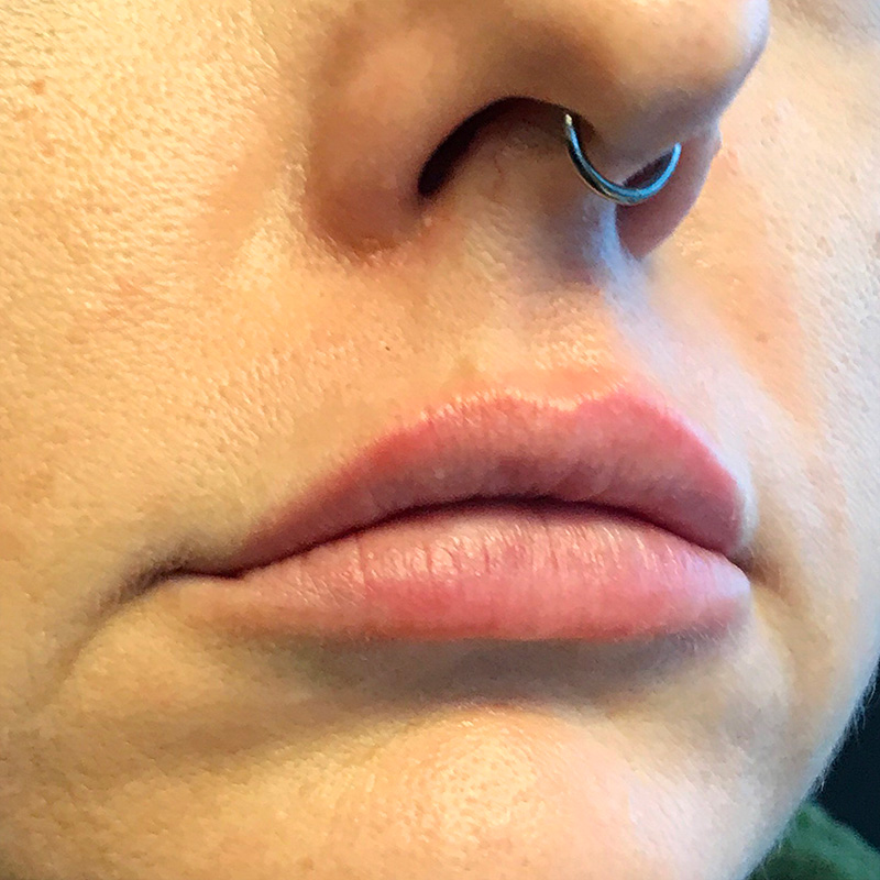 Injectables And Fillers 88