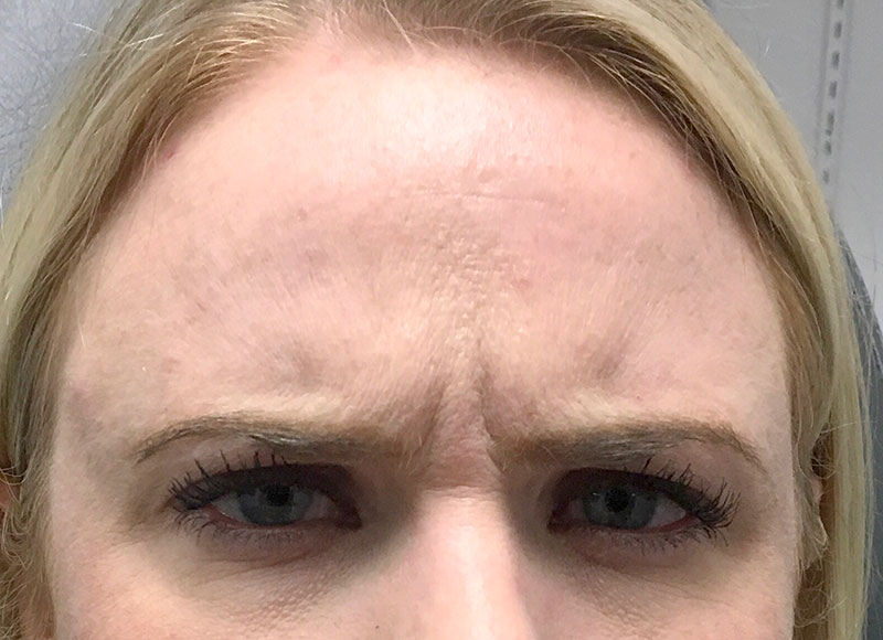 Injectables And Fillers 01