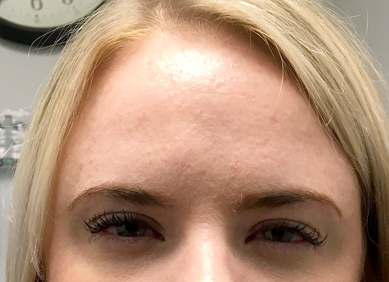 Injectables And Fillers 90