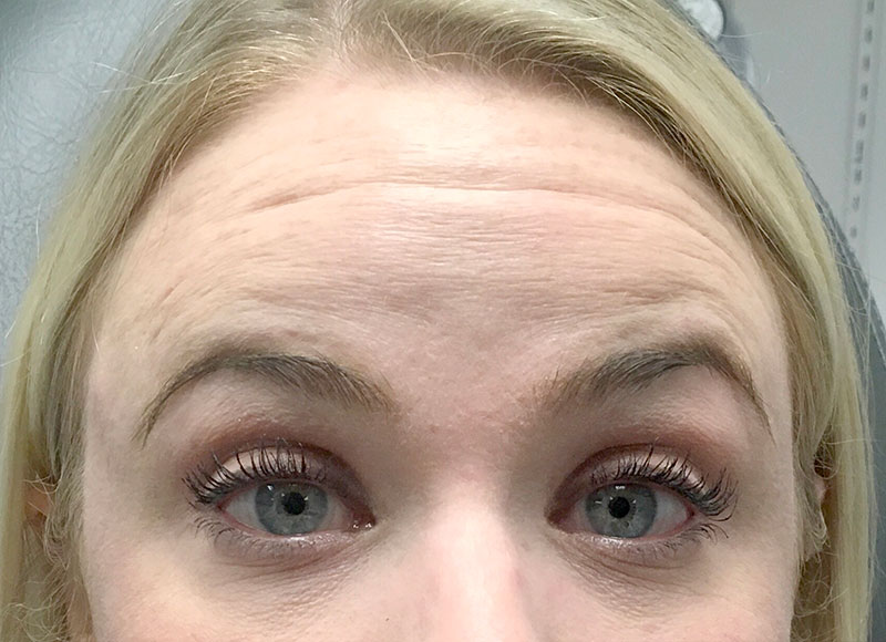 Injectables And Fillers 03