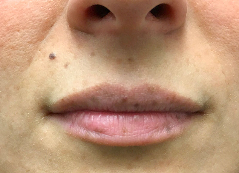 Injectables And Fillers 01