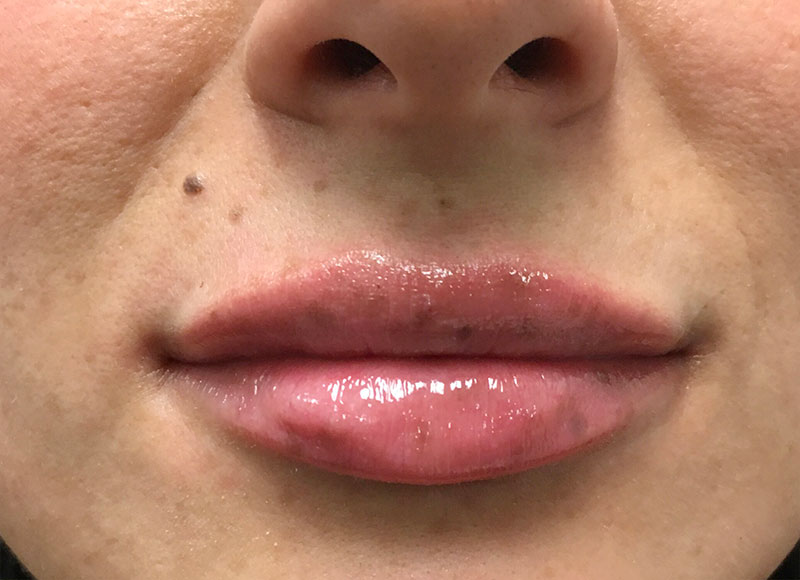 Injectables And Fillers 92