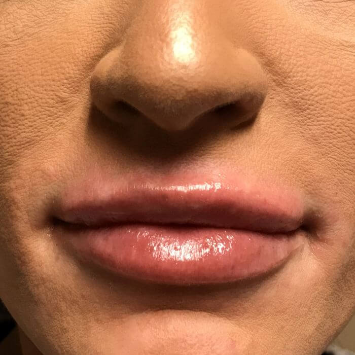 Injectables And Fillers 96