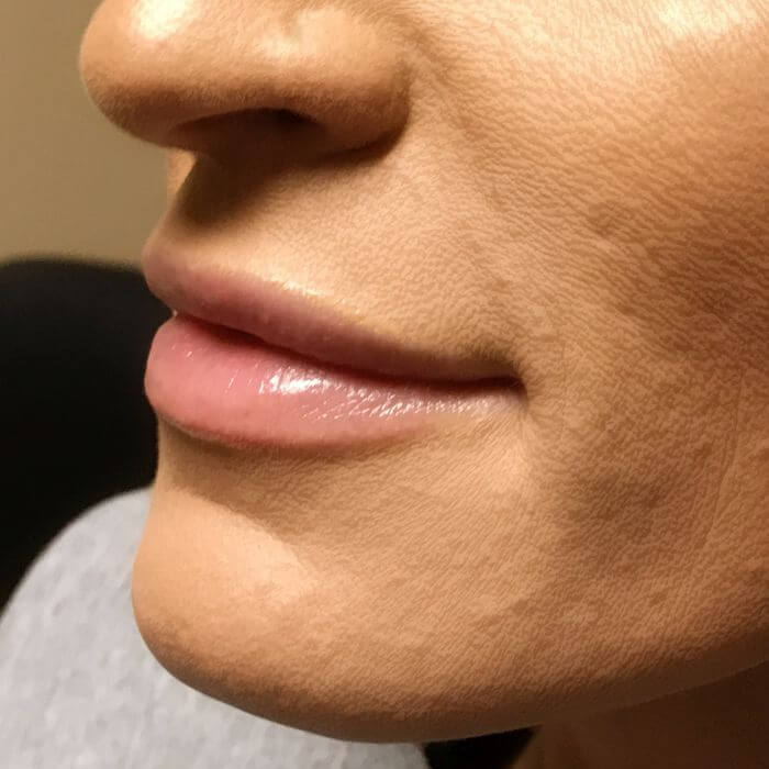 Injectables And Fillers 03