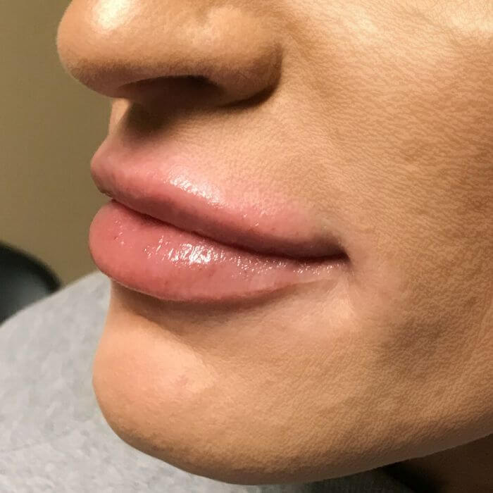 Injectables And Fillers 03