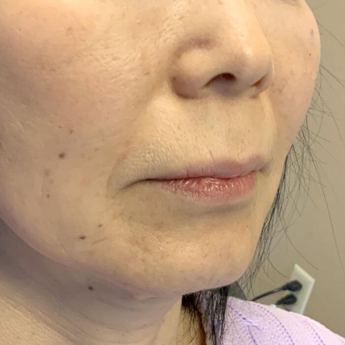 Injectables And Fillers 03