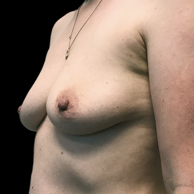 Inverted Nipple Repair 03