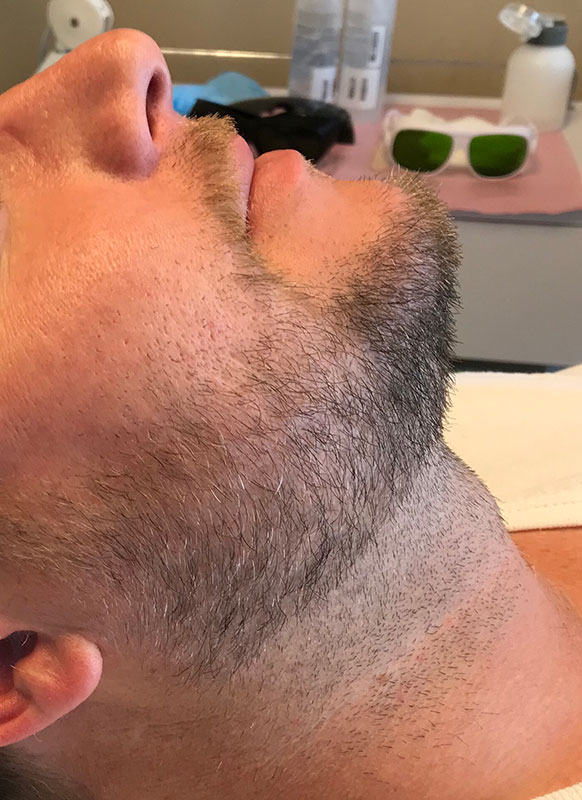 Laser Hair Removal 01