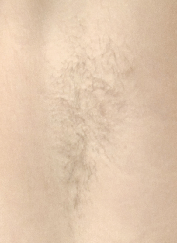 Laser Hair Removal 01