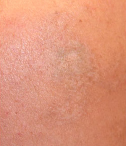 Laser Tattoo Removal 01