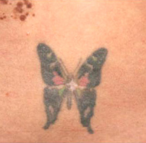 Laser Tattoo Removal 01