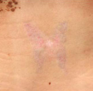 Laser Tattoo Removal 02
