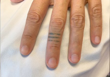 Laser Tattoo Removal 01