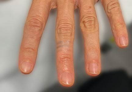 Laser Tattoo Removal 03