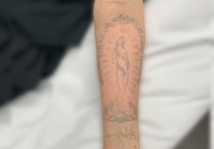 Laser Tattoo Removal 04
