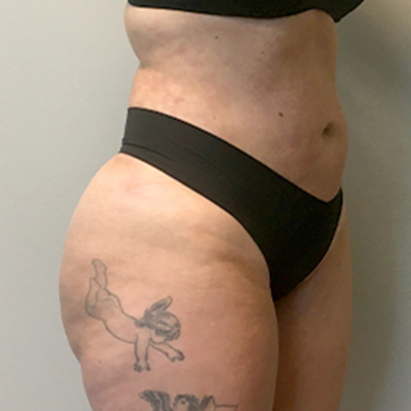 Liposuction Abdomen 07