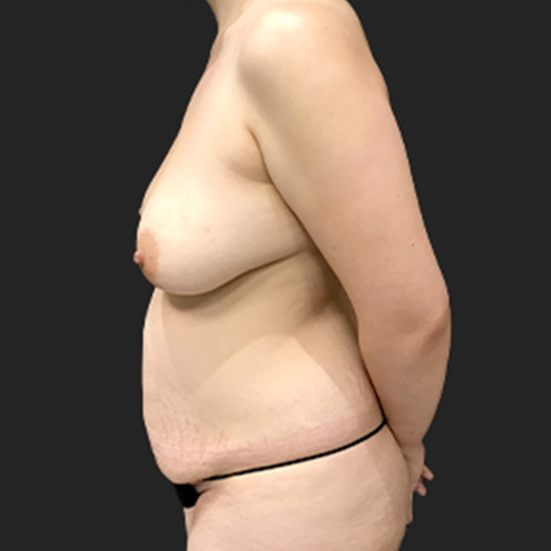 Liposuction Abdomen 09