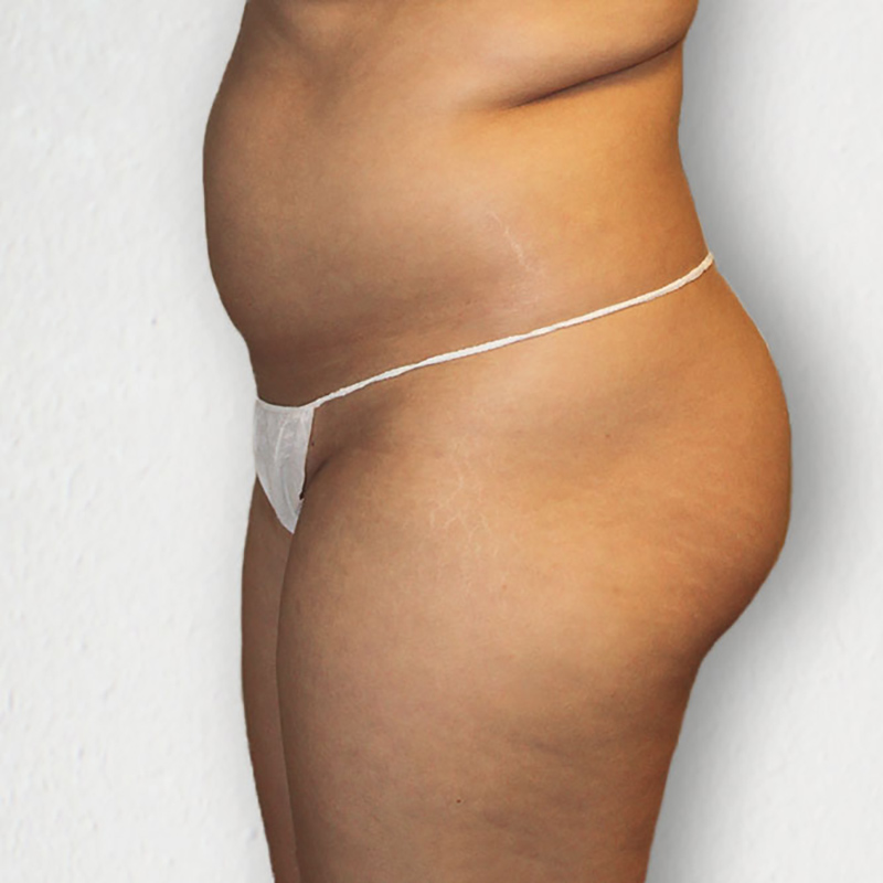 Liposuction Abdomen 01