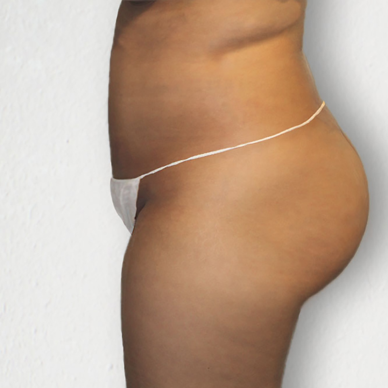Liposuction Abdomen 08