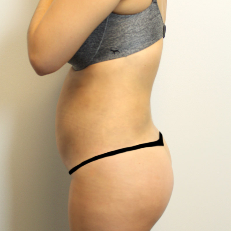 Liposuction Abdomen 03