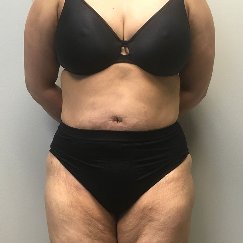 Liposuction Abdomen 15