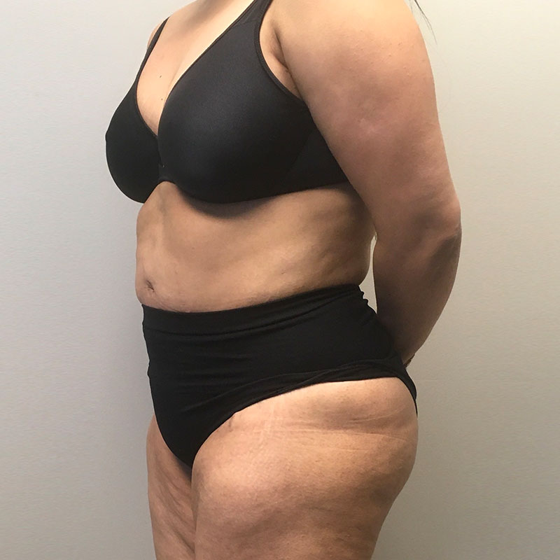 Liposuction Abdomen 03