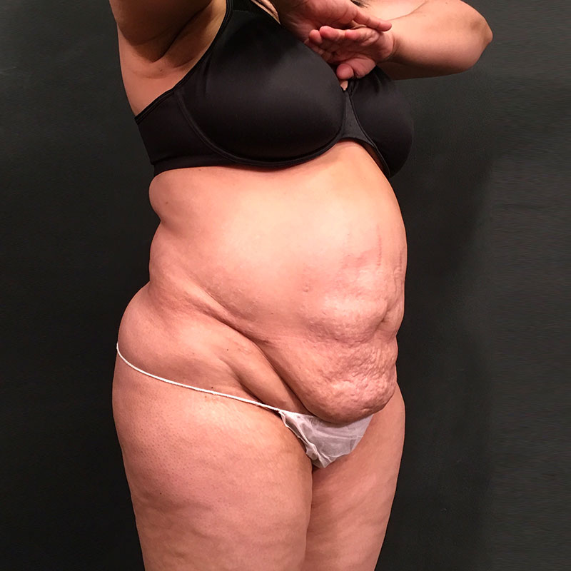 Liposuction Abdomen 05