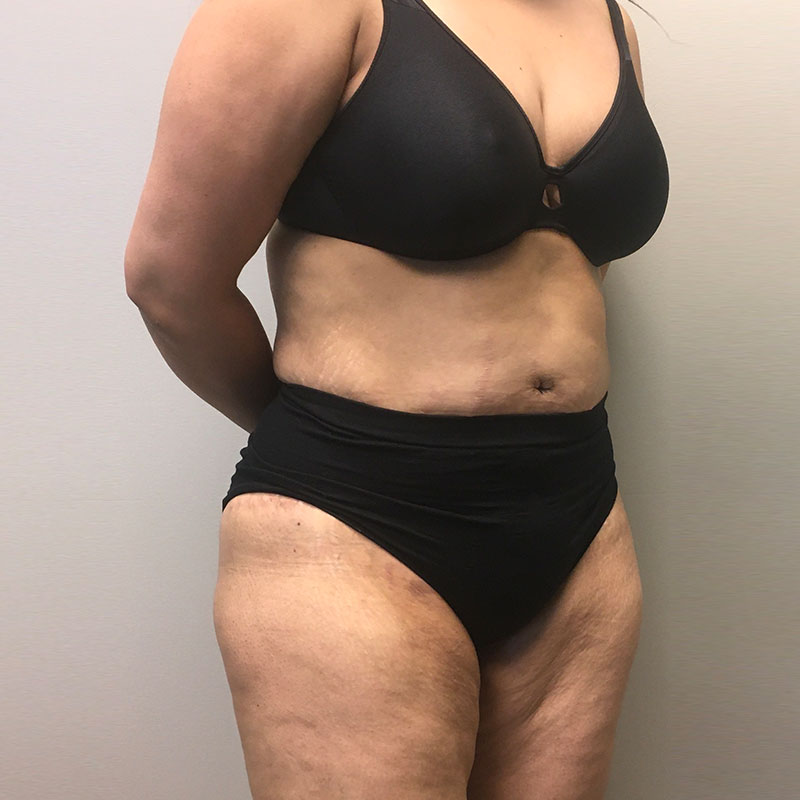 Liposuction Abdomen 05